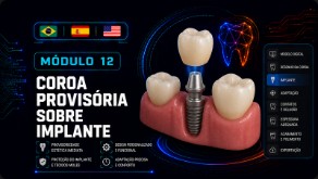 Coroa Provisória sobre Implante